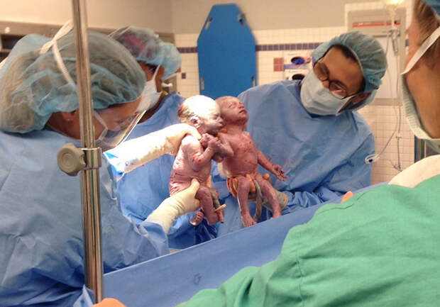 В мае 2014 года моноамниотические близнецы Дженна и Джиллиан Тислтуэйт родились, держась за руки   близняшки, дети, за руки