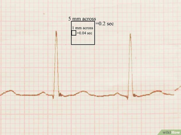 Изображение с названием Read an EKG Step 2