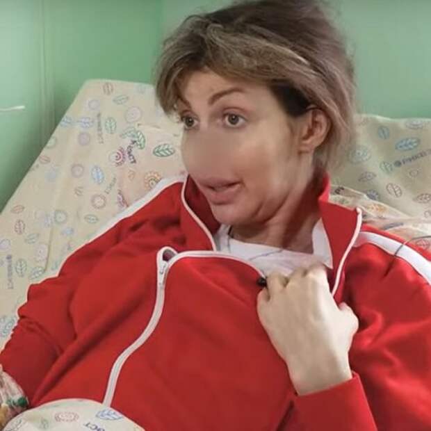 Волосы поседели, а нос исчез: Малахов показал изуродованное лицо экс-жены Аршавина