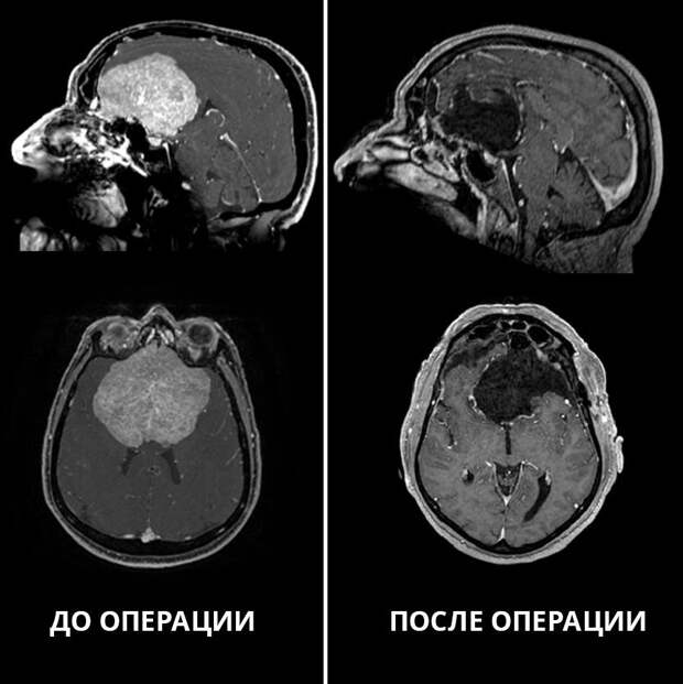 В НМИЦ им. ак. Е.Н. Мешалкина Минздрава России поступил мужчина с гигантским новообразованием головного мозга и жалобами на изменение в поведении. У него пропало обоняние, ухудшились память и зрение. У пациента постоянно было приподнятое без причины настроение, неконтролируемое мочеиспускание, а также ослабление самокритики.