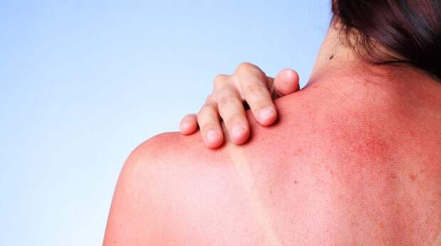 Аллергия на солнце: что это такое и как себя защитить