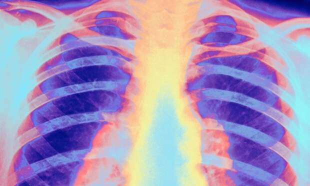 Chest X-ray showing pulmonary tuberculosis. 