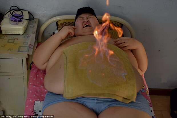 11-летний Ли Ханг, страдающий от синдрома Прадера — Вилли, проходит традиционную китайскую процедуру в центре по снижению веса в мире, дети, жизнь