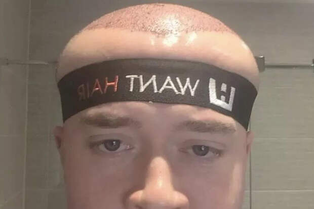 Mirror: британец стал похож на Мегамозга после пересадки волос