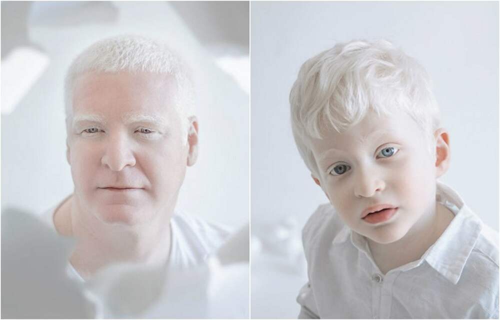 Как люди рождаются альбиносами. Альбинизм 1в. Аниридия альбинизм. Генетические заболевания альбинизм.