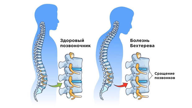 Болезнь Бехтерева: причины появления, симптомы, диагностика и методы лечения