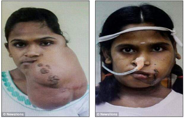 Индийская девочка улыбнулась впервые за 14 лет после того, как хирурги удалили опухоль с ее лица индия, медицина, опухоль, пластическая хирургия