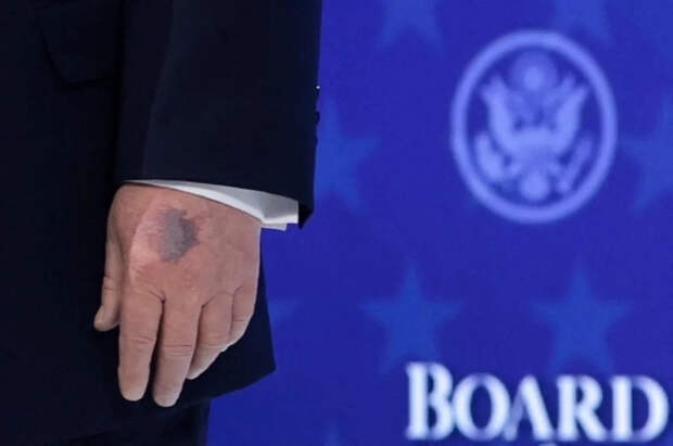 Трамп раскрыл тайну своего синяка, который пресса обнаружила в Давосе