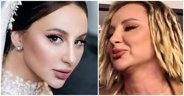 Анна Дзюба из группы "Artik & Asti" прибегнула не только к редакторам, но и к помощи хирургов: она сделала грудь, ягодицы, подтяжку лица, но вот только в жизни работа мастеров красоты выглядит несовершенной Анна Дзюба из группы "Artik & Asti" прибегнула не только к редакторам, но и к помощи хирургов: она сделала грудь, ягодицы, подтяжку лица, но вот только в жизни работа мастеров красоты выглядит несовершенной