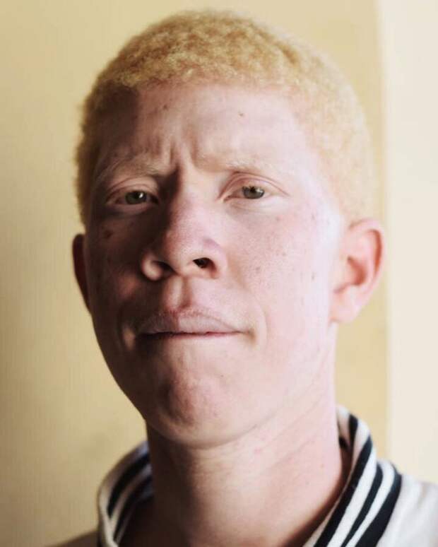Как выглядят альбиносы разных рас 