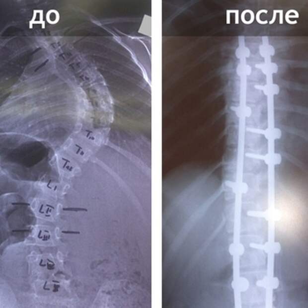 Восстановление детей после. Металлический штырь в позвоночник. Металлоконструкция на позвоночнике при сколиозе.