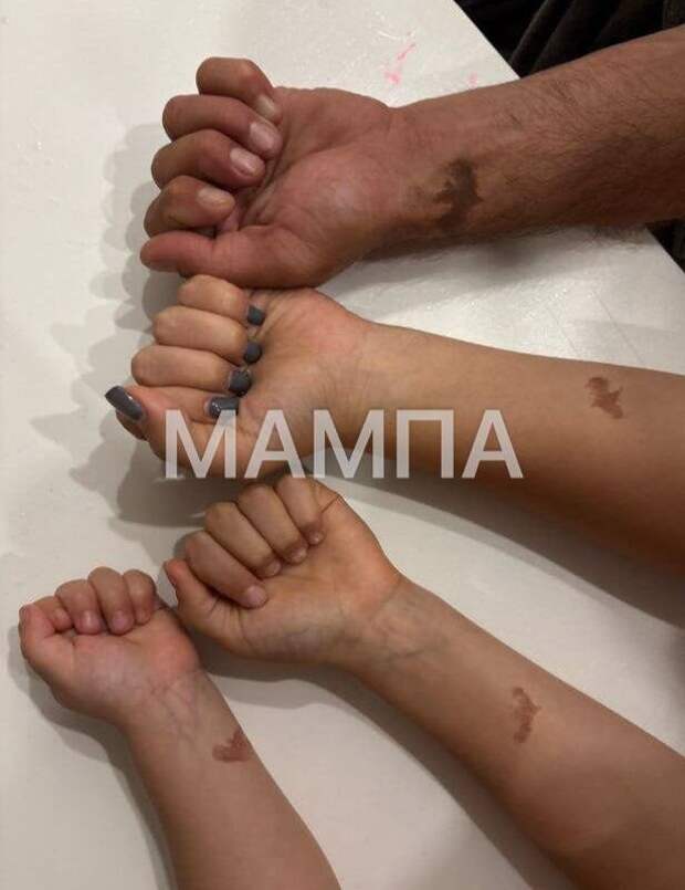 Во Владивостоке четверо детей родились с родимыми пятнами в форме летучей мыши