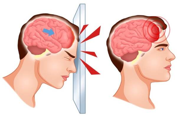 Этот "тихий" симптом сотрясения мозга может остаться с вами навсегда — не игнорируйте его!