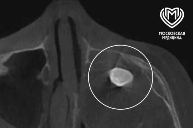 Врачи Филатовской больницы удалили зуб из носа 15-летнего подростка