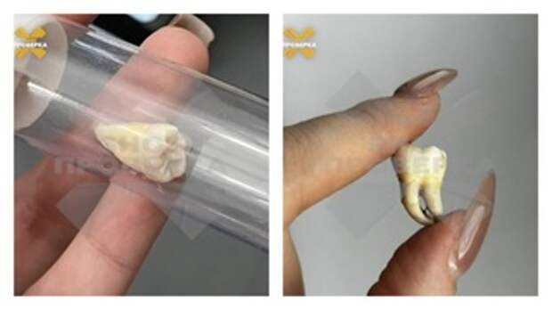 Купленный зуб мудрости / Фото: