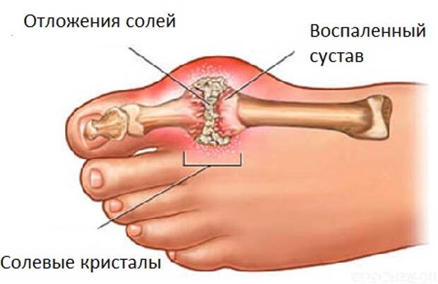 Подагра признаки