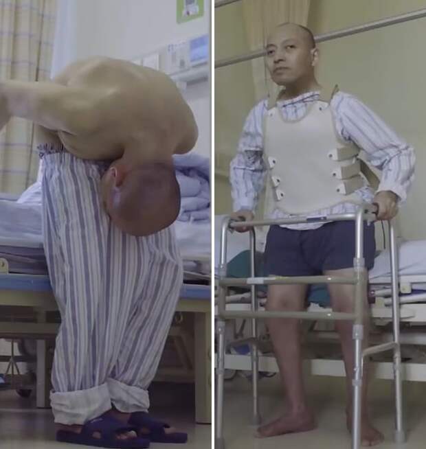 Житель Китая 20 лет прожил согнувшись пополам