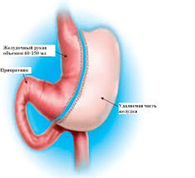 Удаление части желудка