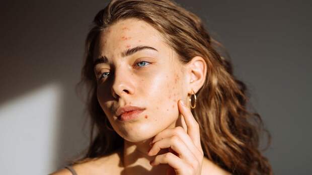 Дерматолог объяснил связь прыщей на лбу и стресса