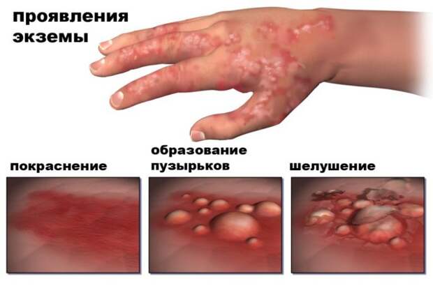 Как избавиться от экземы