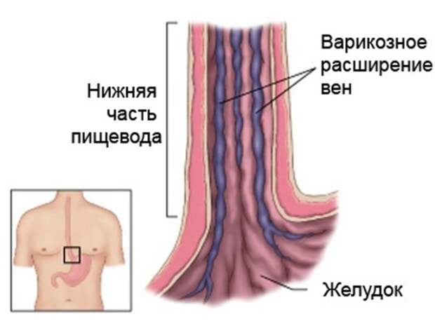 Кровотечение из расширенных вен пищевода: возможные причины, симптомы, проведение диагностических исследований, диагноз и лечение