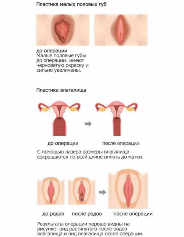 Пластика клитора: назначение, алгоритм работы, время проведения, показания, специфика процедуры, необходимые инструменты и последствия пластики