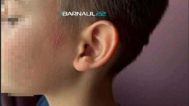 Ссадины у мальчика / Фото: Telegram-канал Barnaul 22