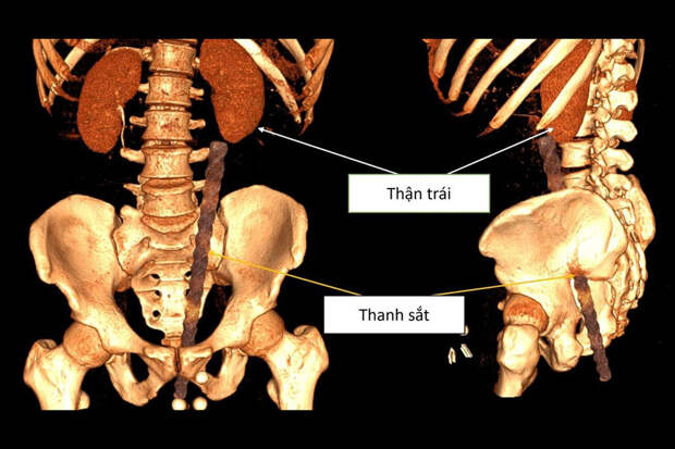 Вьетнамец упал ягодицами на металлический пруд и попал в больницу