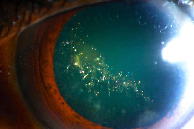 ScienceAlert: глаза могут искриться при "рождественской катаракте"