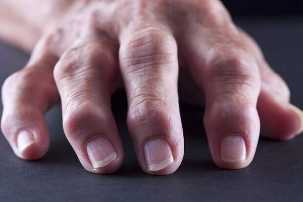 Артроз пальцев рук - болезнь музыкантов или возрастная?