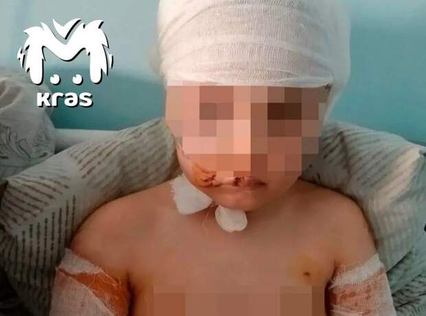 Mash: появилось фото девочки, искусанной стаей собак в Диксоне