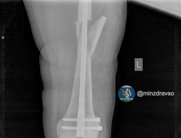 На Урале спасли беременную, упавшую с высоты