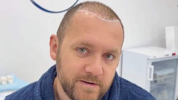 Звезда сериалов «Мажор» и «Бывшие» показал внешность после пересадки волос