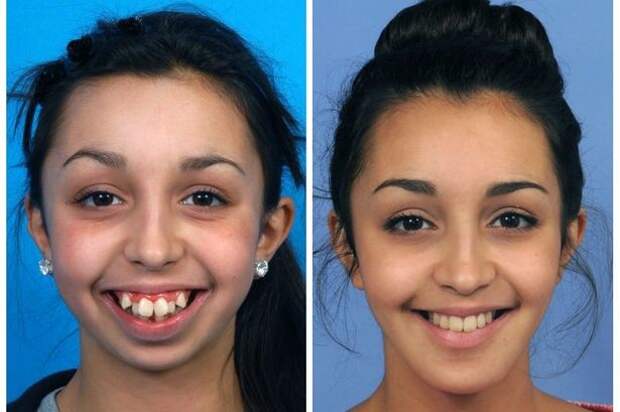 Невероятное преображение девушки после пластической коррекции челюсти зубы, преображение, челюсть