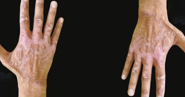 Уникальные мутации интегрина блокируют иммунитет против плоских бородавок