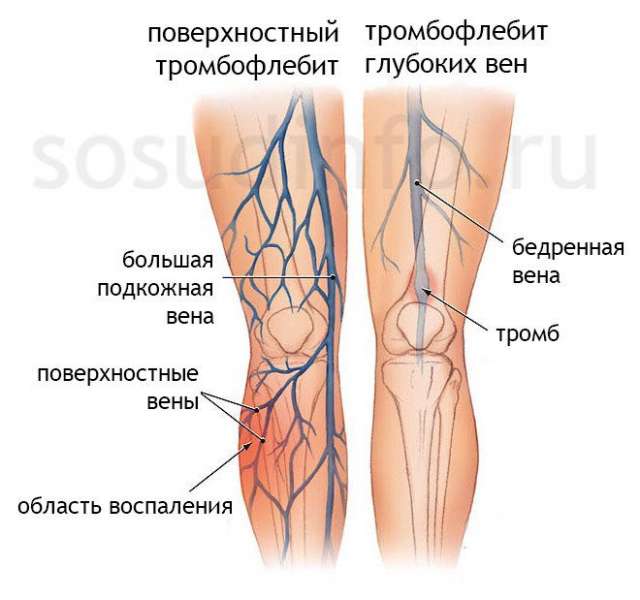 Симптомы тромба, которые вы не должны игнорировать