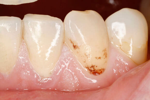 Стоматолог Хритова: сахар и кислоты в энергетиках наносят зубам двойной удар