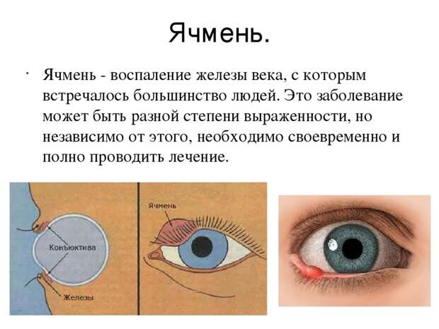 Ячмень на глазу: 8 актуальных и безопасных способов борьбы Ячмень на глазу: 8 актуальных и безопасных способов борьбы