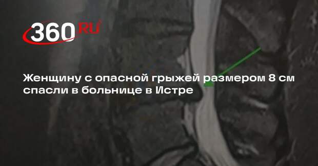 Женщину с опасной грыжей размером 8 см спасли в больнице в Истре