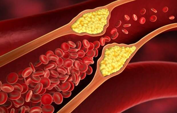 Высокий уровень “плохого” холестерина грозит развитием болезни Альцгеймера