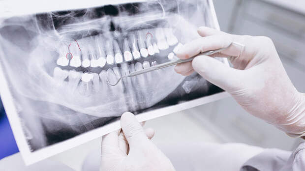 Потерю зубов связали с лишним весом