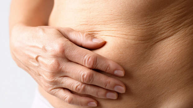 Хирург назвала способ избавиться от обвисшей кожи после похудения