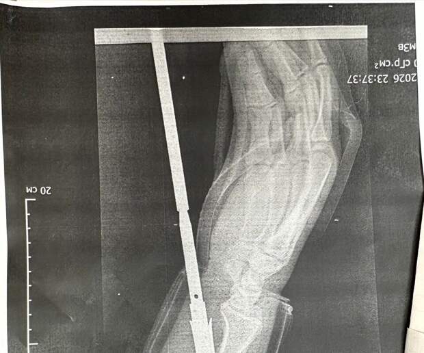 Медики помогли жителю Орска, выстрелившему из арбалета себе в руку