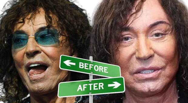 Ножи американских хирургов: как Валерий Леонтьев лишился сна из-за неудачной пластики и теперь не может закрыть глаза