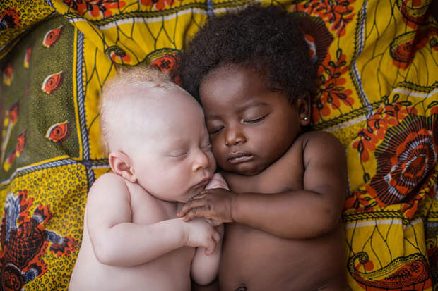 Темнокожий младенец держит малыша-альбиноса во сне. история, факты