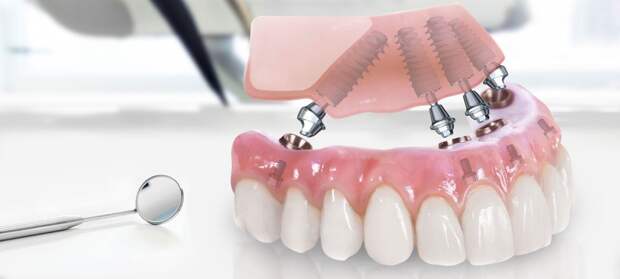 Предложен новый метод создания высокопрочных имплантатов