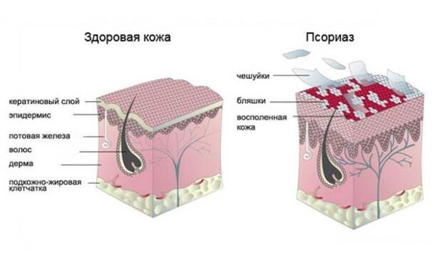 Всё, что нужно знать о псориазе