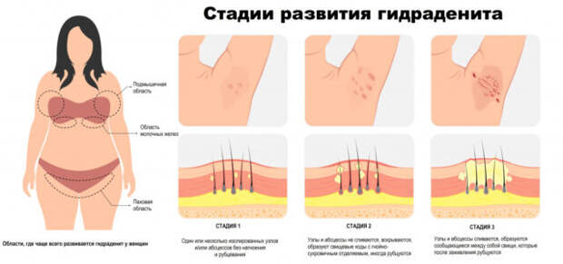 гнойный гидраденит