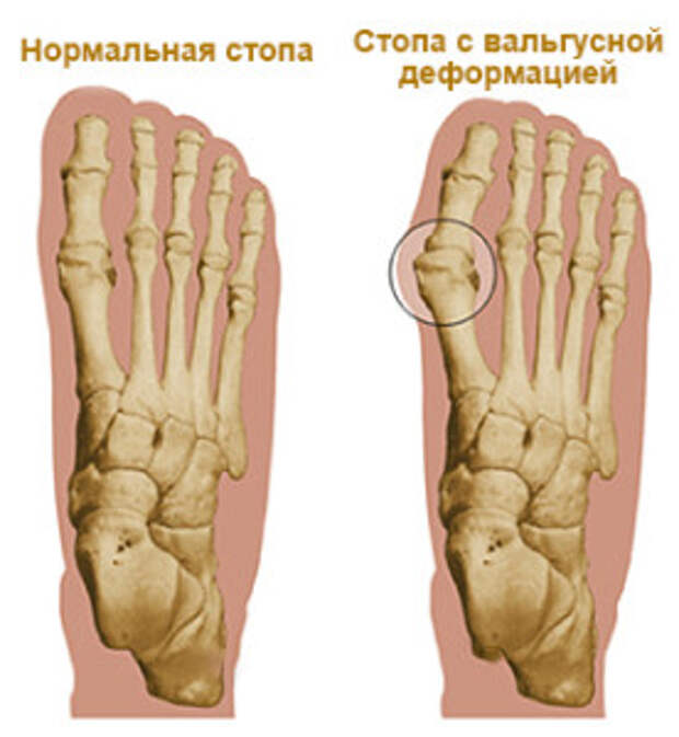 Косточка на большом пальце ноги