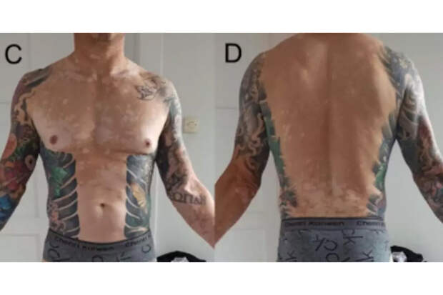 LADBible: поляк перестал потеть и потерял все волосы после сделанной татуировки
